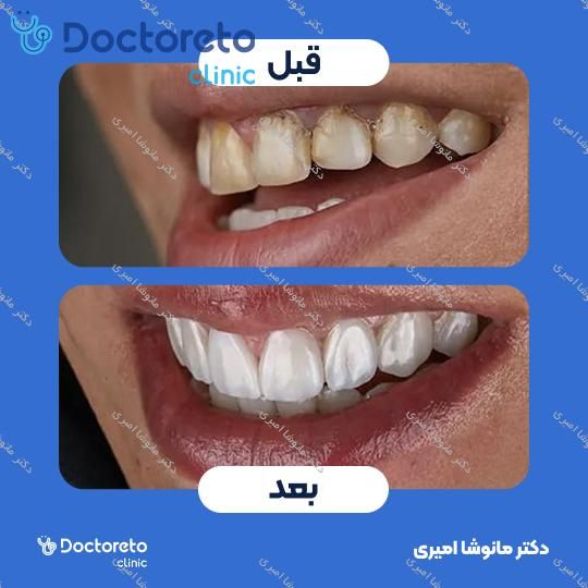 ونیر کامپوزیت (هر واحد)