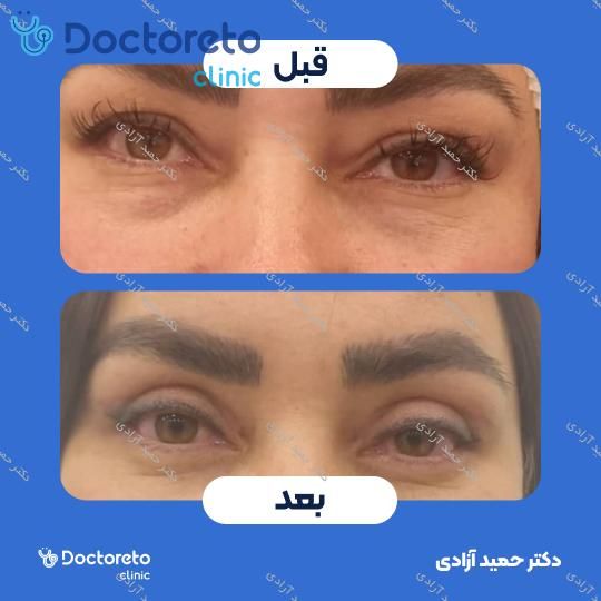 بلفاروپلاستی به روش جراحی