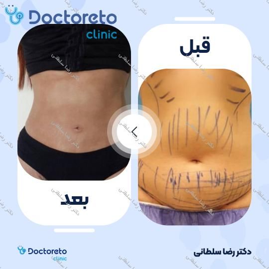 لیپوماتیک شکم و پهلو ها و پشت