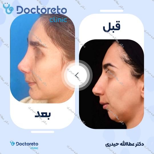 عمل جراحی مجدد زیبایی بینی (رینوپلاستی)