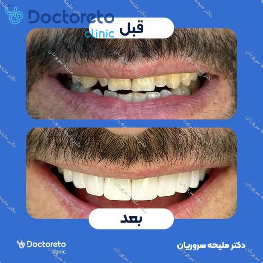 لمینت سرامیکی دندان