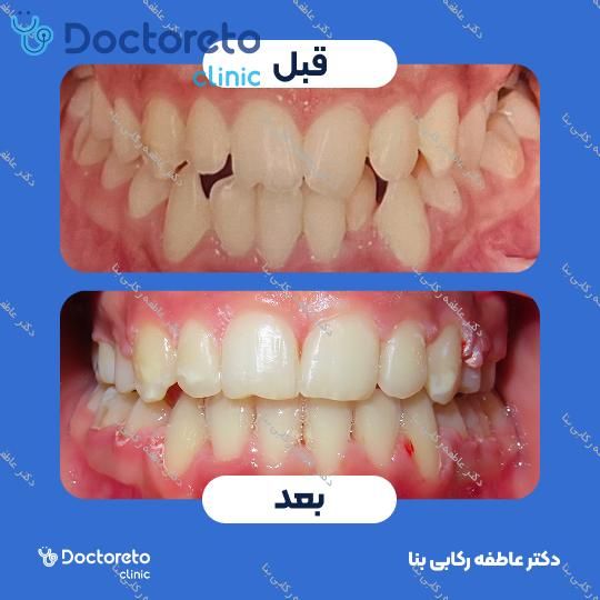 ارتودنسی سرامیکی ( دو فک )