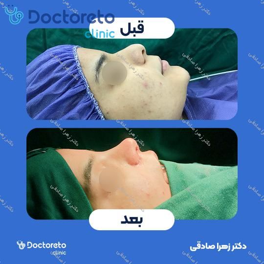 جراحی انحراف بینی (سپتوپلاستی)