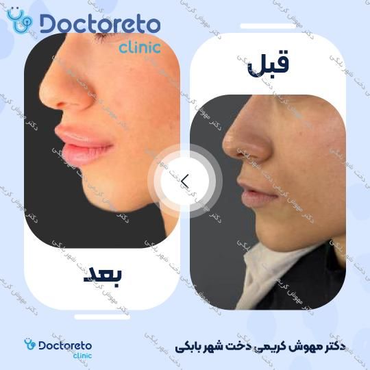 تزریق ژل لب با برند نورامیس (1cc)