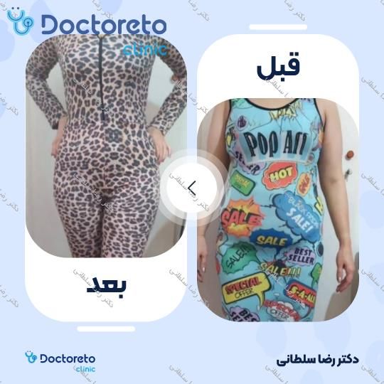 لیپوماتیک شکم و پهلو ها و پشت
