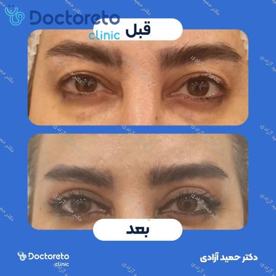 بلفاروپلاستی به روش جراحی