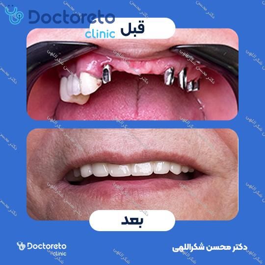 جرمگیری دو فک با بروساژ