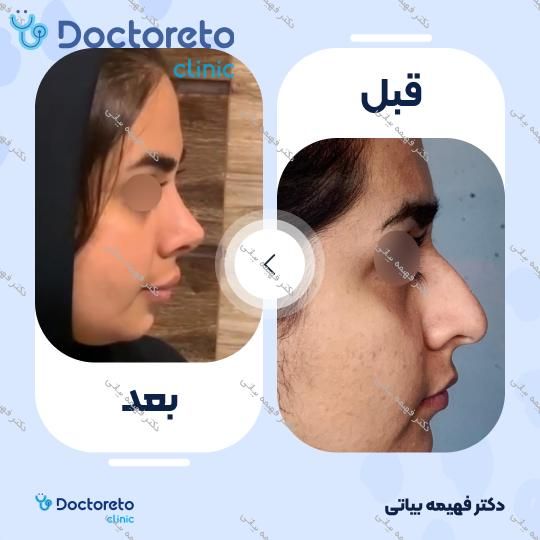 عمل زیبایی بینی (رینوپلاستی)