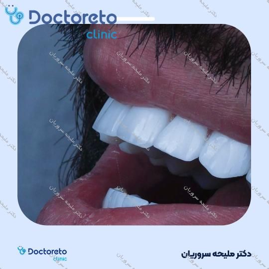 ونیر کامپوزیت (هر واحد)