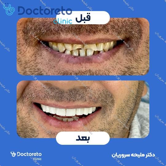 لمینت سرامیکی دندان