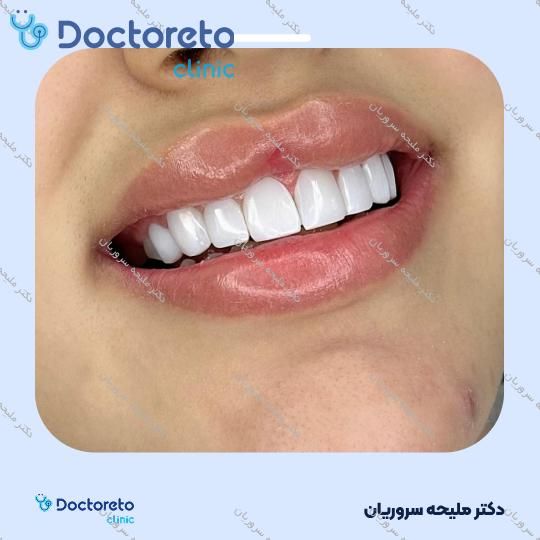 ونیر کامپوزیت (هر واحد)