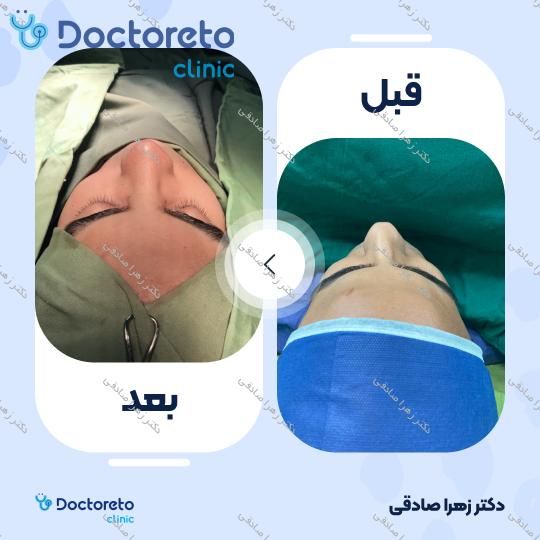 عمل جراحی مجدد زیبایی بینی (رینوپلاستی)