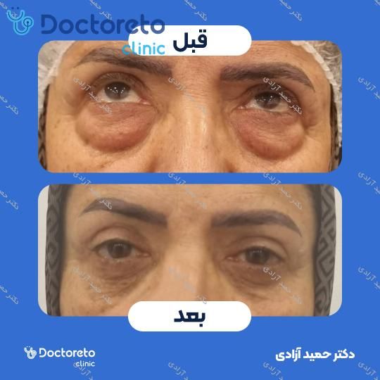 بلفاروپلاستی به روش جراحی