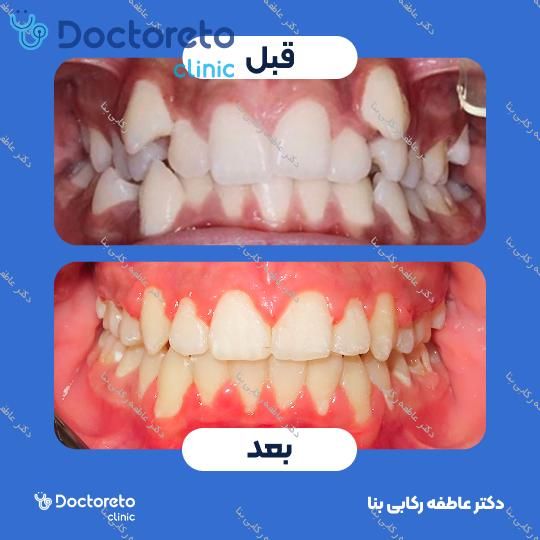 ارتودنسی نامرئی (دو فک)