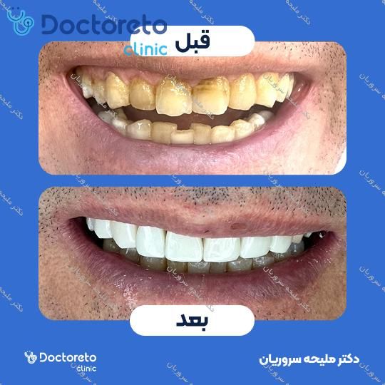 لمینت سرامیکی دندان
