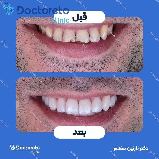 ونیر کامپوزیت دندان (هرواحد)