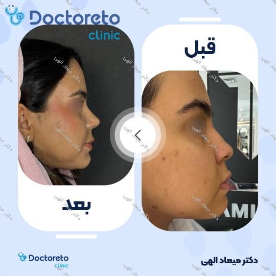 عمل زیبایی بینی با بیهوشی (رینوپلاستی)