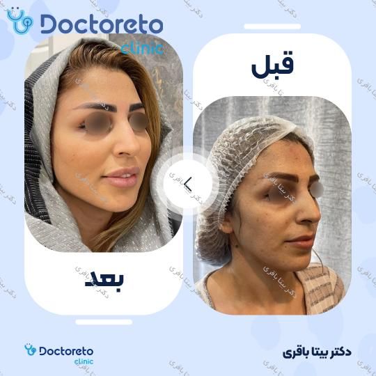 جوانسازی صورت با مزوژل
