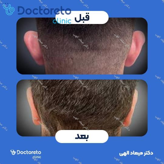 عمل زیبایی گوش (اتوپلاستی)