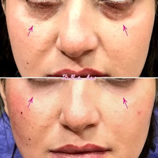 تزریق ژل زیر چشم با برند ژوابکس (1cc)