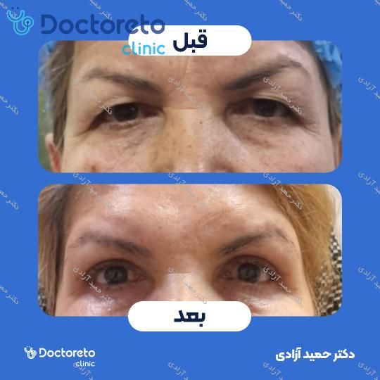 بلفاروپلاستی به روش جراحی