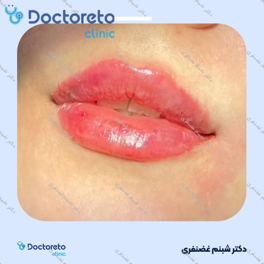 تزریق ژل لب