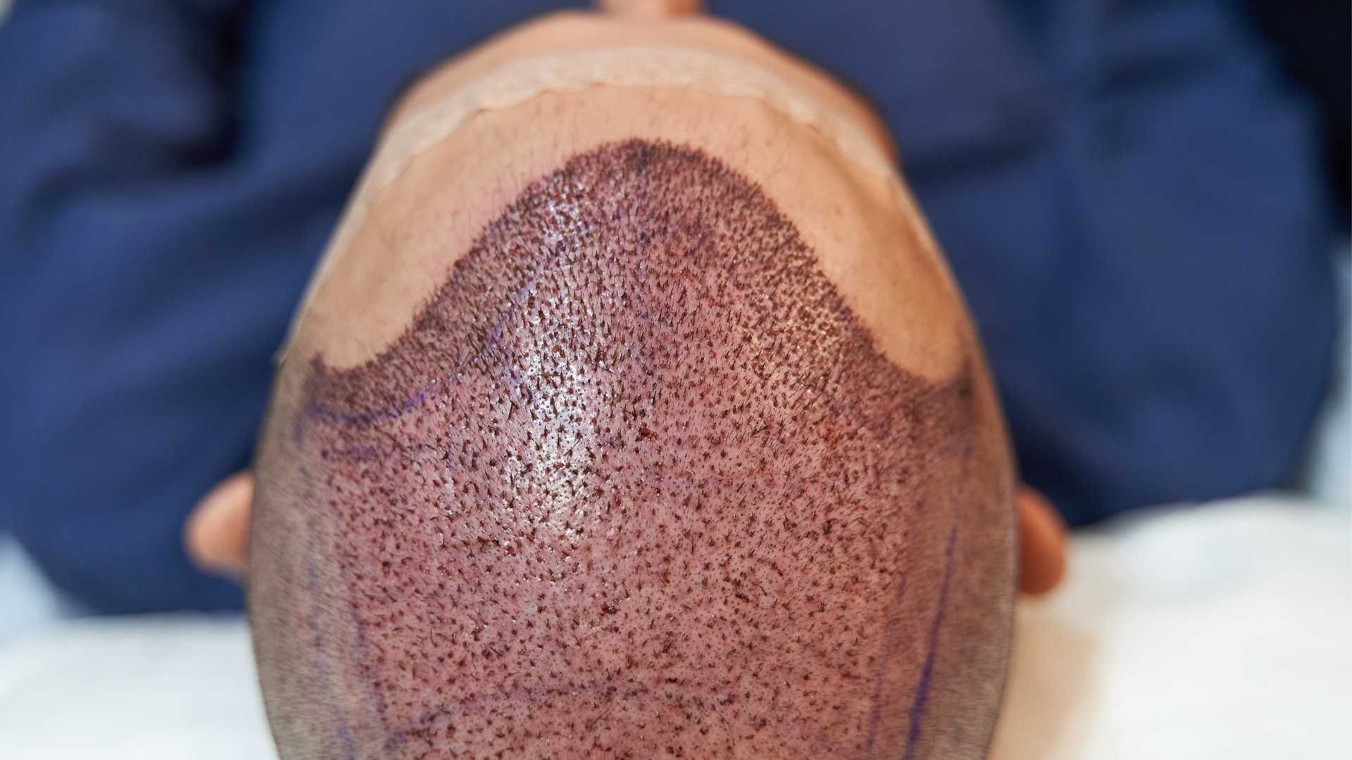 کاشت مو به روش FIT