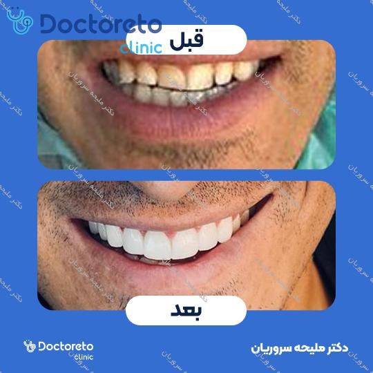 لمینت سرامیکی دندان