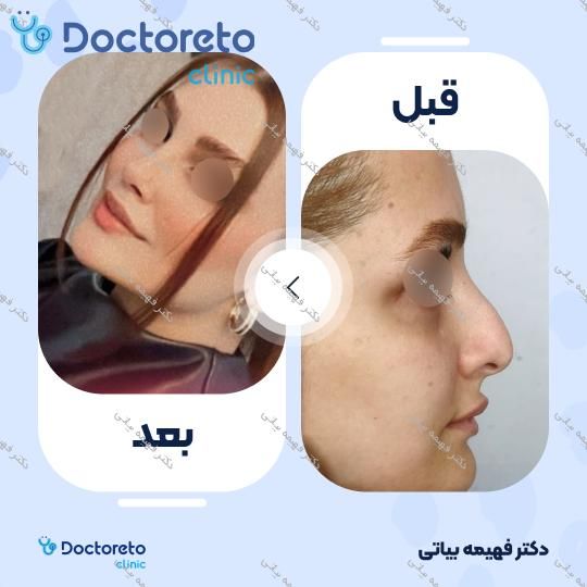 عمل زیبایی بینی (رینوپلاستی)