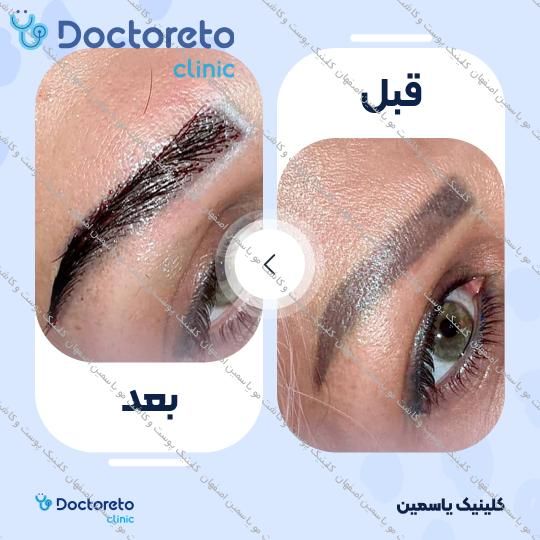 کاشت ابرو