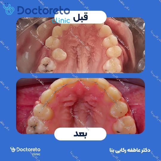 ارتودنسی ثابت ( یک فک )