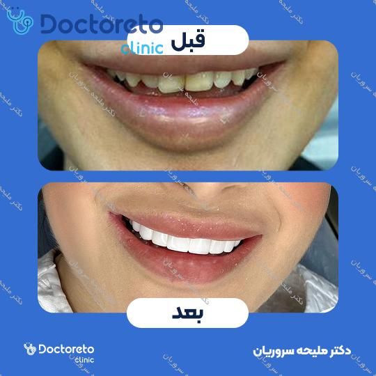 لمینت سرامیکی دندان