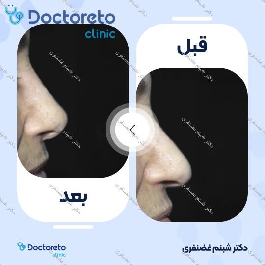 تزریق ژل بینی