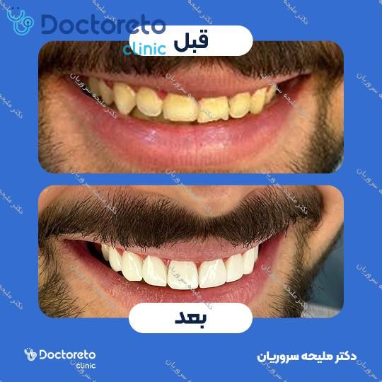 لمینت سرامیکی دندان