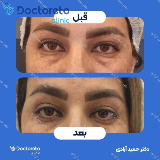 بلفاروپلاستی به روش جراحی