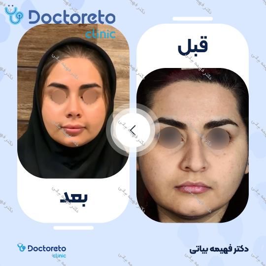 جراحی انحراف بینی (سپتوپلاستی)