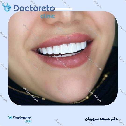 ونیر کامپوزیت (هر واحد)
