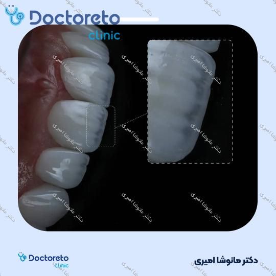 لمینت سرامیکی دندان (هر واحد)
