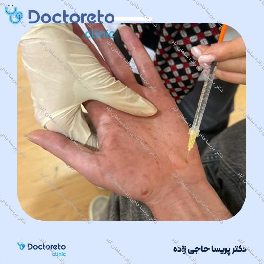 تزریق بوتاکس ضد تعریق (هایپر هیدروسیس)