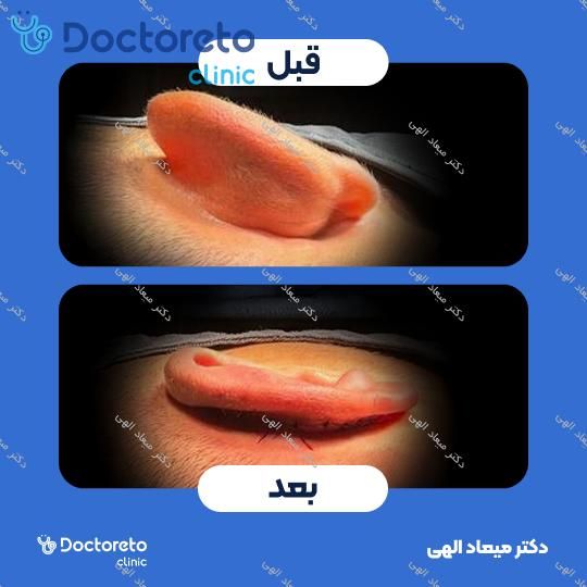 عمل زیبایی گوش (اتوپلاستی)