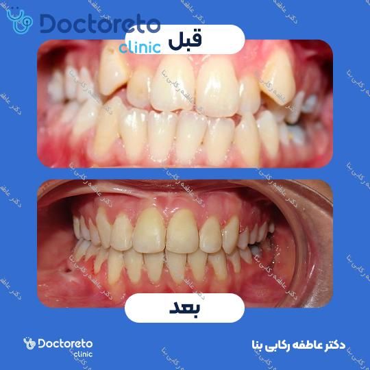 ارتودنسی متحرک (دو فک) (اصلاح رشد)