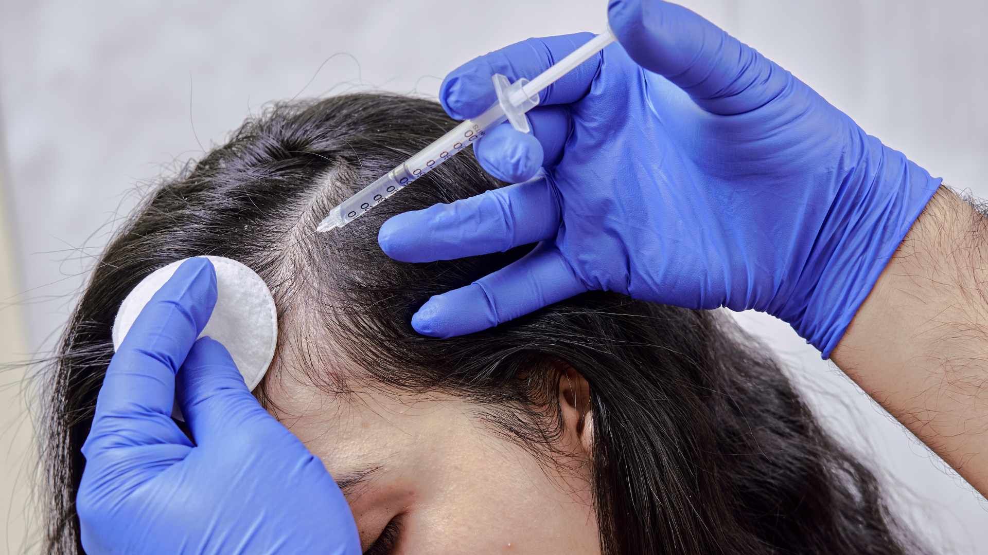 تزریق مزوتراپی موی سر (هر جلسه)