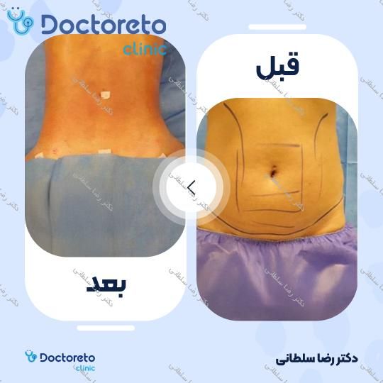 لیپوماتیک شکم و پهلو ها و پشت