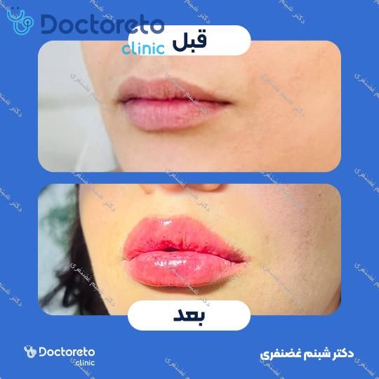 تزریق ژل لب