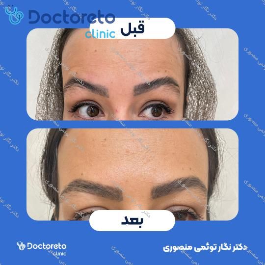تزریق بوتاکس صورت (پیشانی، خط اخم، دور چشم) با برند مصپورت