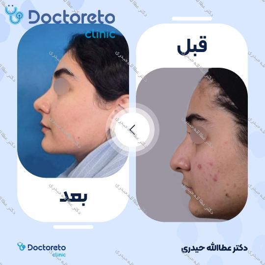 عمل جراحی مجدد زیبایی بینی (رینوپلاستی)