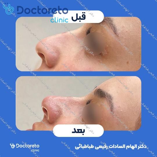 تزریق ژل صورت