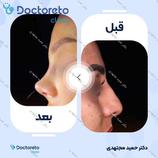 جراحی بینی ترمیمی