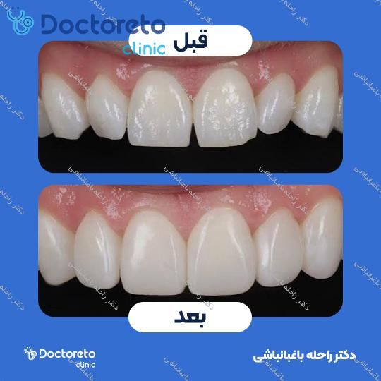 ونیر کامپوزیت (هر واحد)