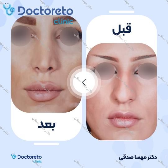 عمل انحراف بینی